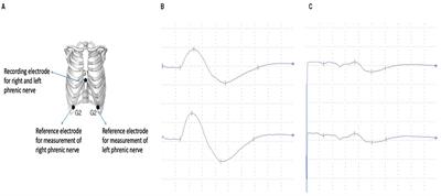 Decreased phrenic nerve compound muscle action potential, inspiratory muscle strength, and exercise capacity after COVID-19